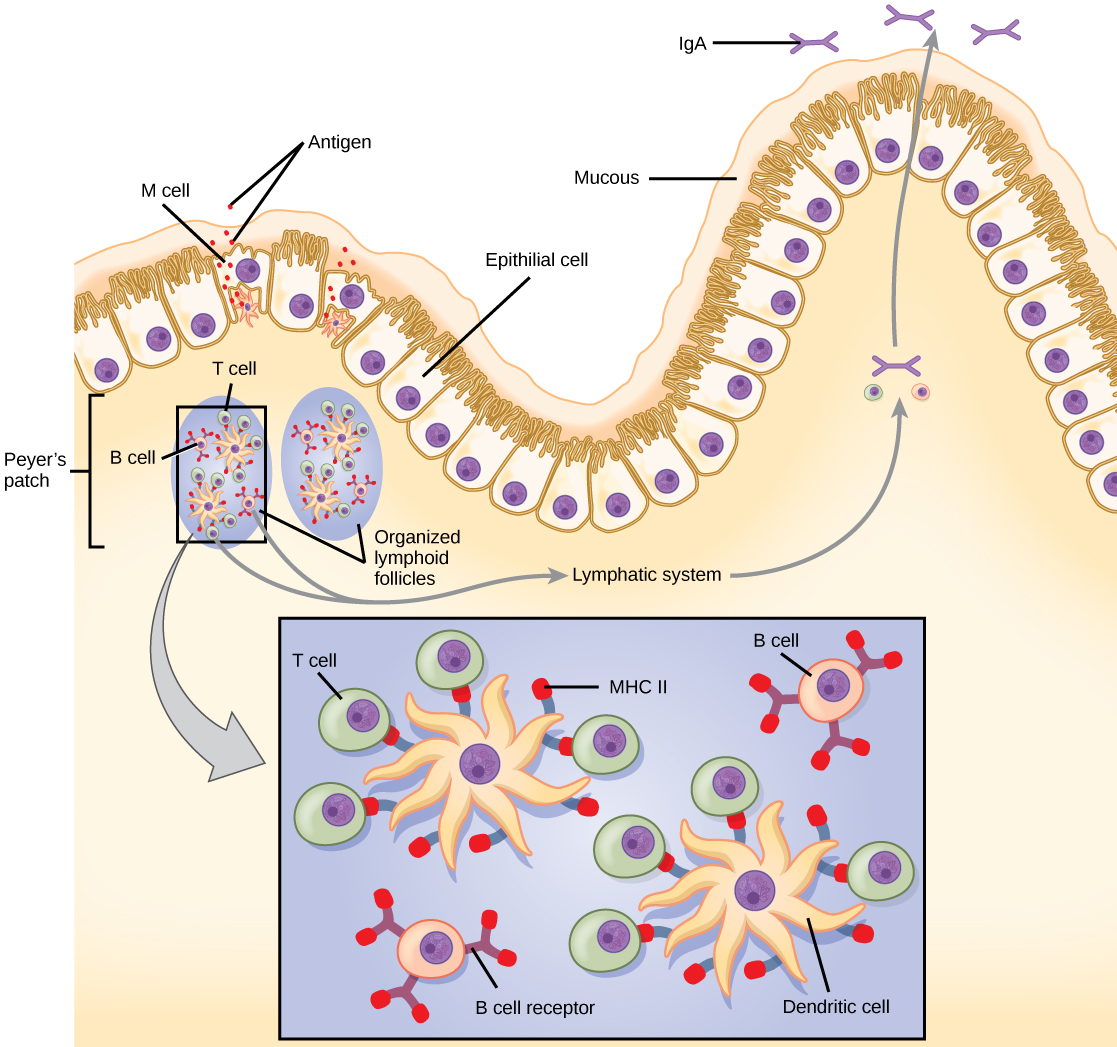 The intestine is lined with epithelial cells with hair-like cilia extending into the intestinal lumen. M cells are sandwiched between these epithelial cells, in bump-like projections in the intestinal lining. The M cells are shaped like an upside-down U, with the U forming a pocket on the interior surface. Antigens are taken up from the intestinal lumen by the M cells, and excreted into this U-shaped pocket. Dendritic cells in the pocket ingest the antigen, then migrate to an area below of the intestinal lining called a Peyers patch. The dendritic cells, T cells and B cells aggregate to form clumps of cells called organized lymphoid follicles. There, some T cells interact with antigen associated with M H C I I on the surface of the dendritic cells. Some B cells are activated by free antigen. Some antigen-presenting dendritic cells enter the lymphatic system, where more B and T cells are activated in the lymph nodes. The B cells and T cells return to bigger bumps in the intestinal epithelium called MALT effector sites. Antibodies are secreted into the intestinal lumen.