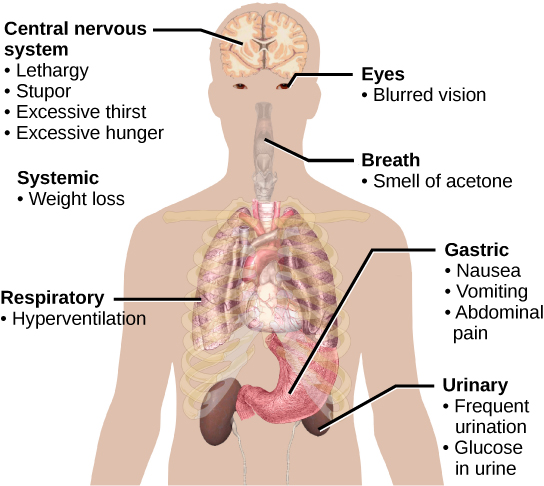 Figure 37.10.  The main symptoms of diabetes are shown. (credit: modification of work by Mikael Häggström)