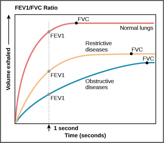 Figure 39.18.  The ratio of FEV1 (the amount of air that can be forcibly exhaled in one second after taking a deep breath) to FVC (the total amount of air that can be forcibly exhaled) can be used to diagnose whether a person has restrictive or obstructive lung disease. In restrictive lung disease, FVC is reduced but airways are not obstructed, so the person is able to expel air reasonably fast. In obstructive lung disease, airway obstruction results in slow exhalation as well as reduced FVC. Thus, the FEV1/FVC ratio is lower in persons with obstructive lung disease (less than 69 percent) than in persons with restrictive disease (88 to 90 percent).
