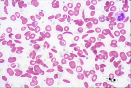 Figure 39.21.  Individuals with sickle cell anemia have crescent-shaped red blood cells. (credit: modification of work by Ed Uthman; scale-bar data from Matt Russell)