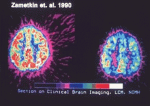 Brain scans of brains with and without ADHD.