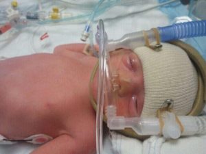 A premature baby on CPAP in the NICU.