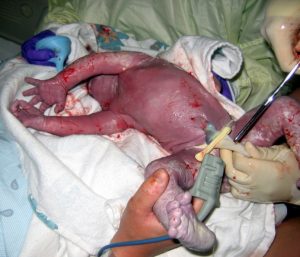 The clamping and cutting of a newborn’s umbilical cord.