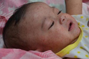 A baby with measles.