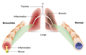 comparison of normal and swollen bronchial tubes in the lungs