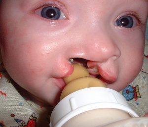 Infant with a cleft lip (opening in the top lip) that makes it difficult to suck on a bottle