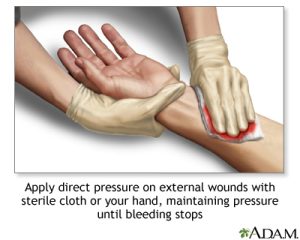 Applying direct pressure on external wounds with a sterile cloth and gloved hand,  maintaining pressure until bleeding stops.