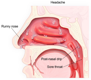 side cut view of nasal passages and throat showing the mucus that is produced when a person has a cold