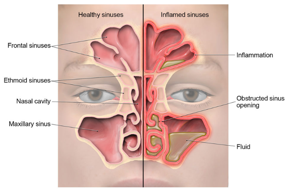 view of healthy vs. inflamed sinuses