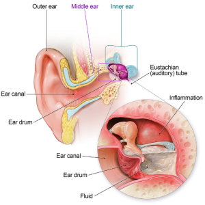 Diagram showing a healthy ear and an infected ear