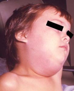 child has swollen salivary glands under the ear making it look like their jaw is swollen