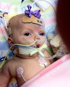 Infant hooked up to life support