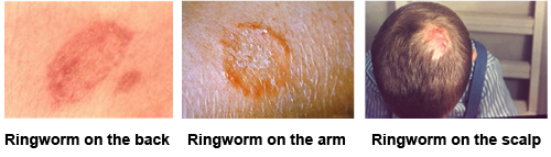 ringworm on the back, on the arm and on the scalp
