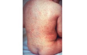 the rash of rubella on a child’s back.