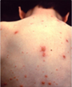 A child's back with multiple chickenpox (red bumps)