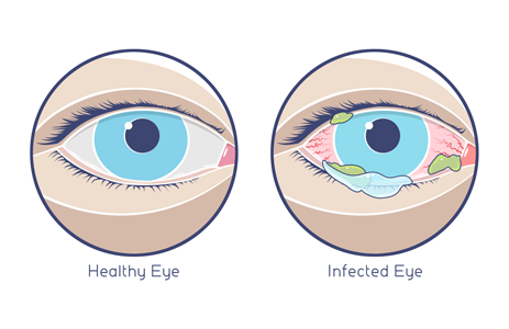 comparison of health and infected eyes; infected eye is read and full of discharge