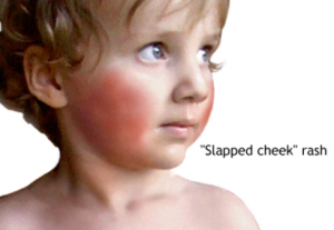 child's cheeks are all red, looking like he was slapped