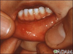 inside of child's bottom lip has small blister-like dots