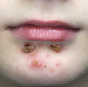 Blisters from impetigo on child's chin