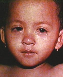 tiny, red spots cover the child's face, neck and body