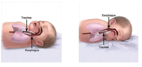 When infant is sleeping on their back, their airway is open, when they sleep on their stomach, their airway is easily blocked.
