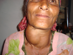 Photo of a Woman with an enlarged growth (goiter) on her neck